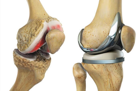 What Is a Total Knee Replacement?